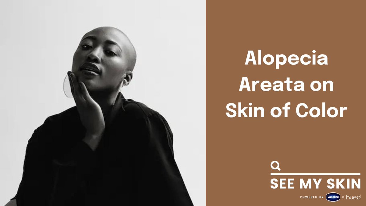 Struggling with alopecia areata? Discover how it affects people of color and explore solutions from The Alopecia Justice League Medical Advisory Board. Check out the full guide 👉🏾 huedco.com/alopecia-areat…

#AlopeciaAreata #SkinOfColor #Dermatology #SeeMySkin #AlopeciaAwareness