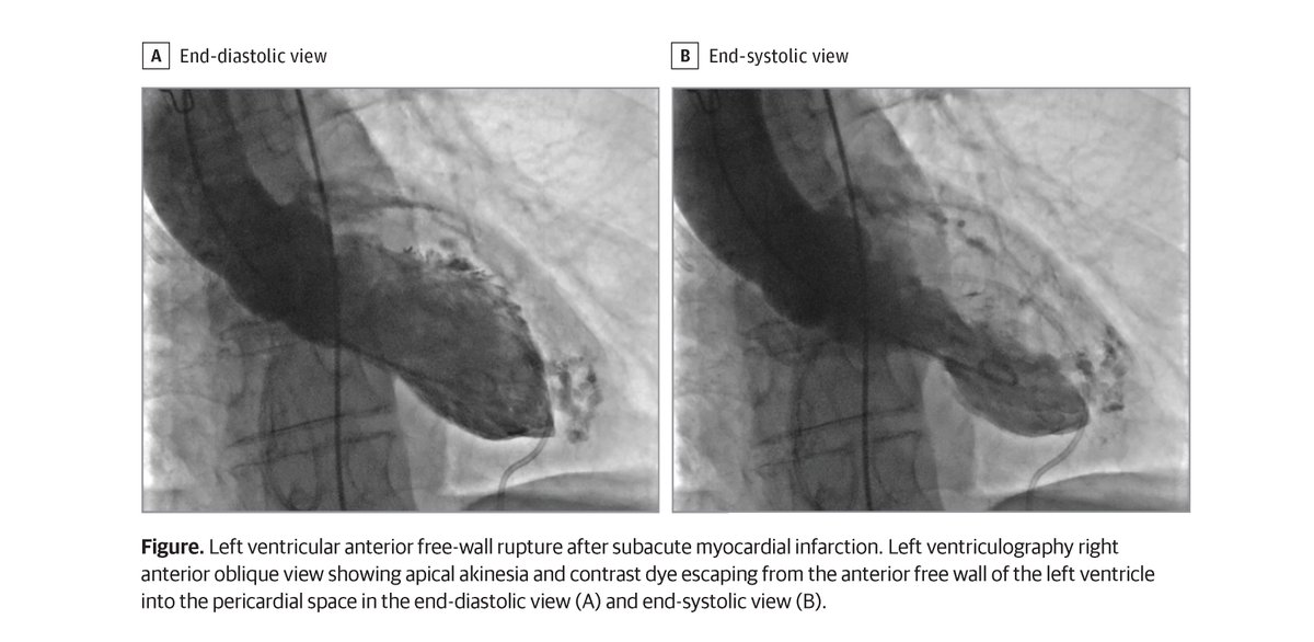Case report: a diagnosis of left ventricular anterior free-wall rupture in a female patient with jaw pain, diagnosed with ST-elevation myocardial infarction, who developed sudden hemodynamic deterioration after administration of anticoagulant therapy. ja.ma/3Ze6zV6