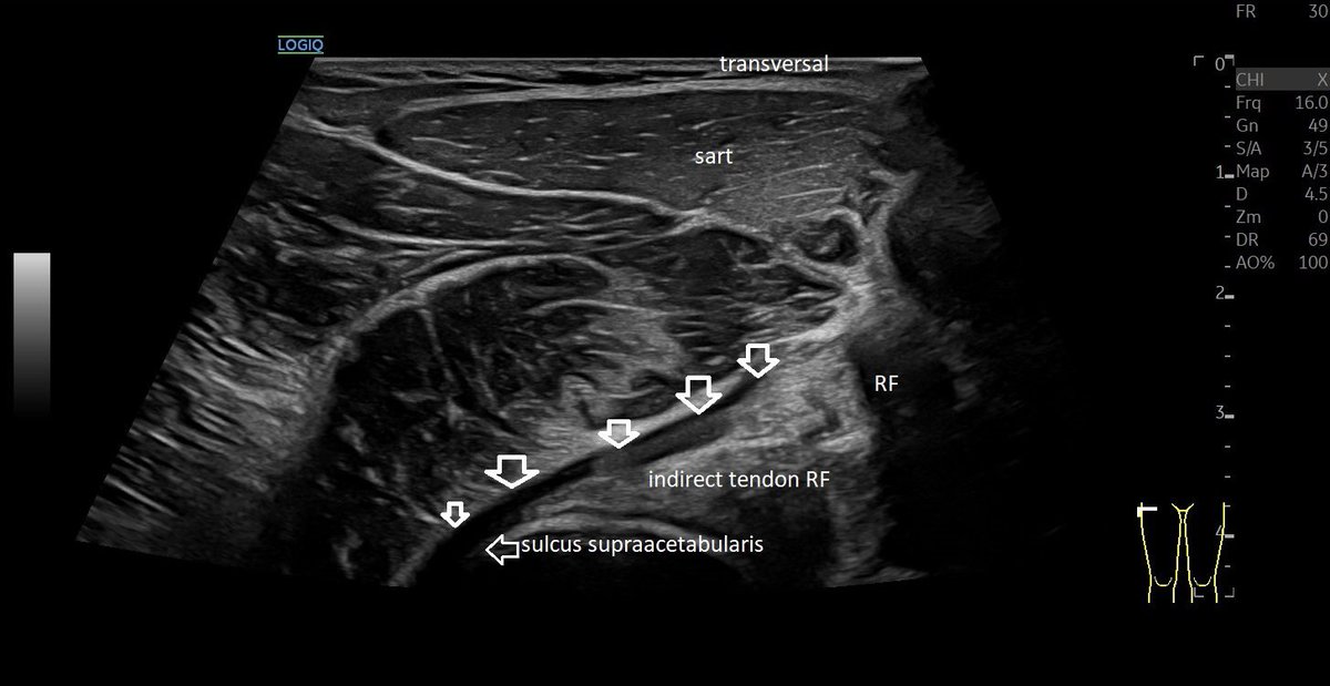 SportklinikBern's tweet photo. Indirectl #rectusfemoris tendon #mskus #pocus #pocushub #GElogiqE10sr4 https://t.co/3WktjELizd