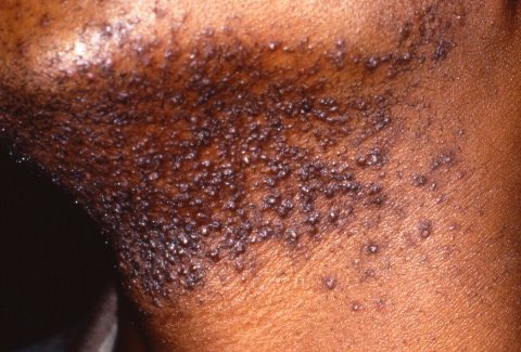 celebritypharm's tweet photo. RAZOR BUMPS: A Common Men’s Skin Struggle 

While some guys have found ways to smooth things out, many still face a tough fight. 

Let’s dive into this issue and explore some solutions together.

Come with me 👇 https://t.co/Lsn0lPgnYL