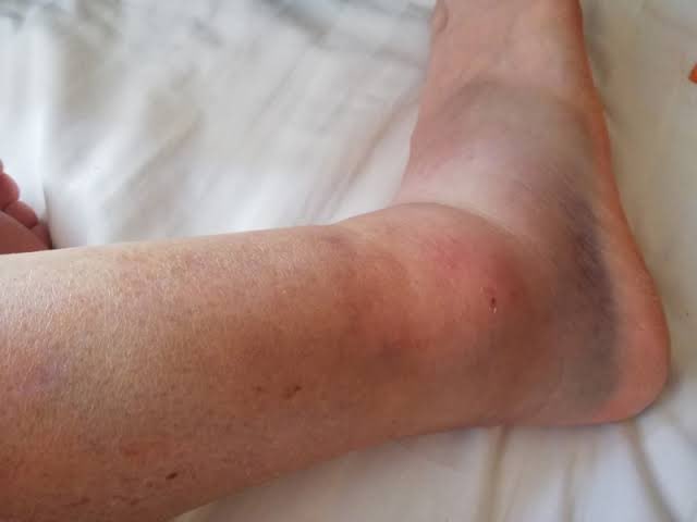 INGET!!!
Klo terkilir/keseleo, JANGAN dipijet/diurut! Bikin susah sembuhnya.

“Tapi tetangga kmren dipijet langsung bs jalan tuh?!”

Kemungkinannya sih:
1. Cederanya emg ringan
2. You broke your swollen ankle. So yg tadinya bengkak, jd lemes krn dipijet. Akibatnya kakimu gagal
