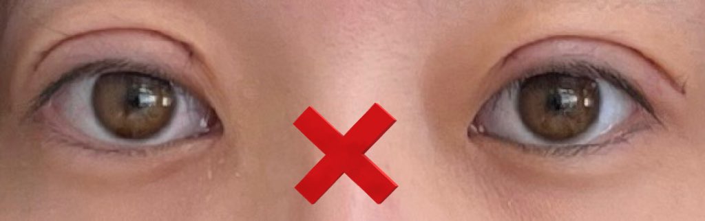 ptiptiman's tweet photo. 右目の目頭のラインと左目尻の皮膚の被さりが気になっていたことに加えてかなりラインが薄くなってたので固定を強める全切開の修正を一週間前にしました！
前回の倍以上腫れてて不安🫨🫨
左目はライン綺麗だけど右目こえええ〜〜〜〜 https://t.co/jhnr0wC1Hz