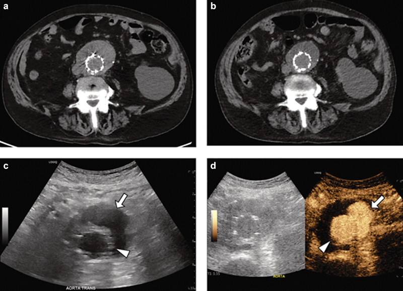 This review explores the applications of contrast-enhanced ultrasound (CEUS) in #interventionalradiology ... thieme-connect.com/products/ejour…

#irad #radtwitter #radiology #MedTwitter
