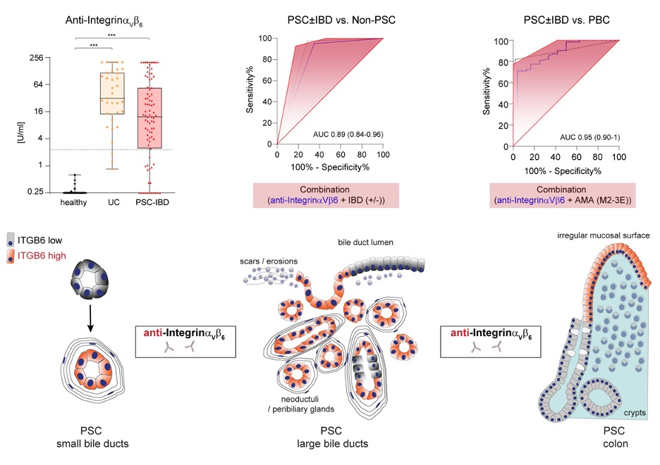 JCC_IBD's tweet photo. Integrin αVß6 - autoantigen and driver of epithelial remodeling in colon and bile ducts in #PSC and #IBD. Roth et al. https://t.co/fPqO0NLLBR https://t.co/Ug5uF1yPBO