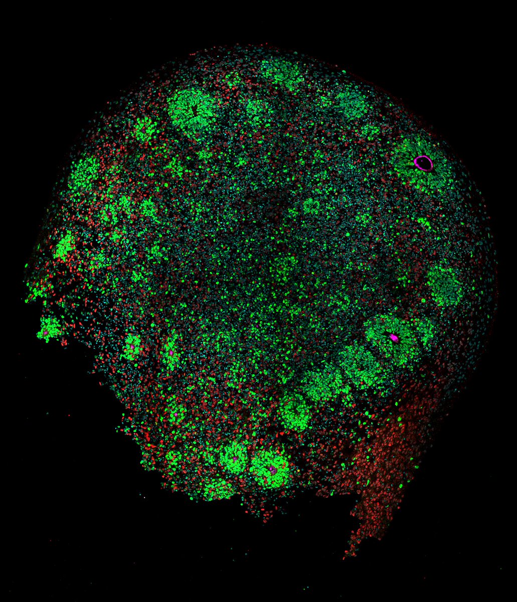 Oliviero Leonardi (@olivieroleonar2) on Twitter photo Excited to present today <a href="/EMBLEvents/">EMBL Events</a> the results of a collaborative work with <a href="/ellylewerissa/">Elly Lewerissa</a> on the role of CHD2 dosage in regulating the pace of human cortical development. Using stem cell derived neurons and organoids we probe recent human evolution in a dish #EESHuman #EvoDevo Excited to present today <a href="/EMBLEvents/">EMBL Events</a> the results of a collaborative work with <a href="/ellylewerissa/">Elly Lewerissa</a> on the role of CHD2 dosage in regulating the pace of human cortical development. Using stem cell derived neurons and organoids we probe recent human evolution in a dish #EESHuman #EvoDevo
