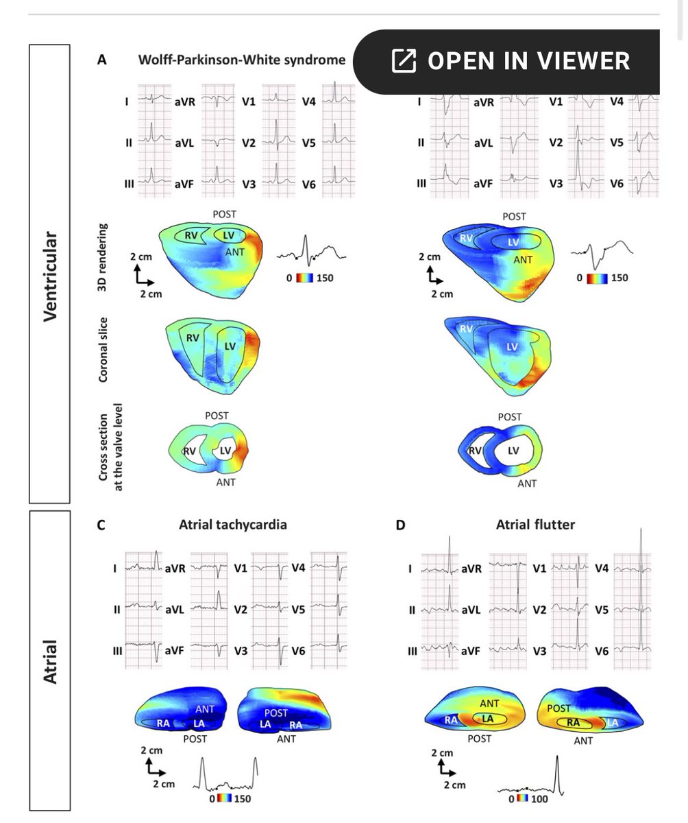 Elaine Wan (@elainewanmd) on Twitter photo Thank you @nih_nhlbi for 5 year funding of AGAPE mechanistic clinical trial on electromechanical wave imaging of arrhythmias with <a href="/ColumbiaUEIL/">Konofagou Lab at Columbia University</a> <a href="/abivianoMD/">Angelo Biviano</a> @NYPCUCVI <a href="/ColumbiaMed/">Columbia Medicine</a> #EPeeps #CardioTwitter science.org/doi/10.1126/sc…. If you have an arrhythmia we will image it! Thank you @nih_nhlbi for 5 year funding of AGAPE mechanistic clinical trial on electromechanical wave imaging of arrhythmias with <a href="/ColumbiaUEIL/">Konofagou Lab at Columbia University</a> <a href="/abivianoMD/">Angelo Biviano</a> @NYPCUCVI <a href="/ColumbiaMed/">Columbia Medicine</a> #EPeeps #CardioTwitter science.org/doi/10.1126/sc…. If you have an arrhythmia we will image it!