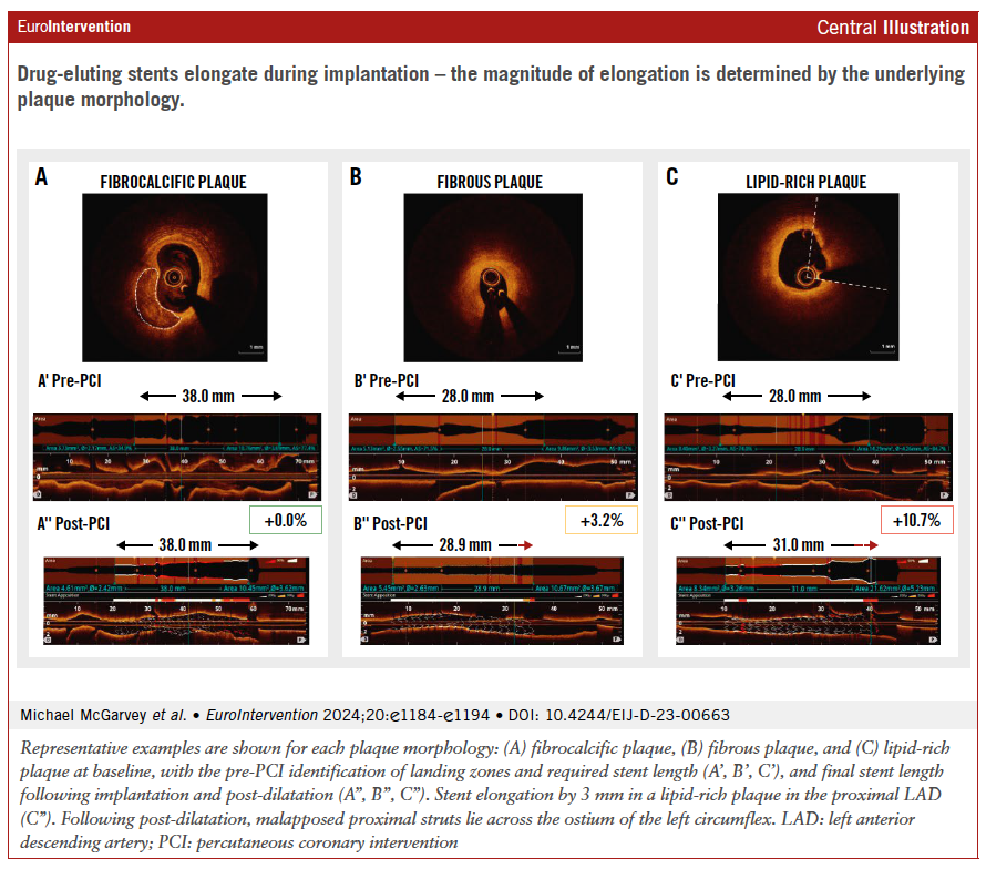 EuroIntervention (@eurointerventio) on Twitter photo In vivo OCT studies reveal that plaque morphology significantly impacts stent elongation during PCI, especially in lipid-rich plaques. This study underscores the importance of plaque analysis in optimizing stent performance. #Cardiology #PCI #OCT #StentElongation
<a href="/DrNileshPareek/">Nilesh Pareek</a> In vivo OCT studies reveal that plaque morphology significantly impacts stent elongation during PCI, especially in lipid-rich plaques. This study underscores the importance of plaque analysis in optimizing stent performance. #Cardiology #PCI #OCT #StentElongation
<a href="/DrNileshPareek/">Nilesh Pareek</a>