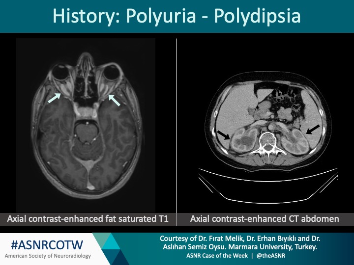 ASNR COTW #213  

Hx: Polyuria and polydipsia

NO SPOILERS! Give hints in the form of GIFs or answer  poll.                     

Answer in 24 hours.                    

#neuro #neurorad #radres #FOAMed #FOAMrad #medtwitter #ASNRCOTW

<a href="/FI_RADS/">Fırat Melik</a> <a href="/mderhanbiyikli/">Erhan Bıyıklı</a> <a href="/asemizoysu/">Aslihan Semiz Oysu</a>