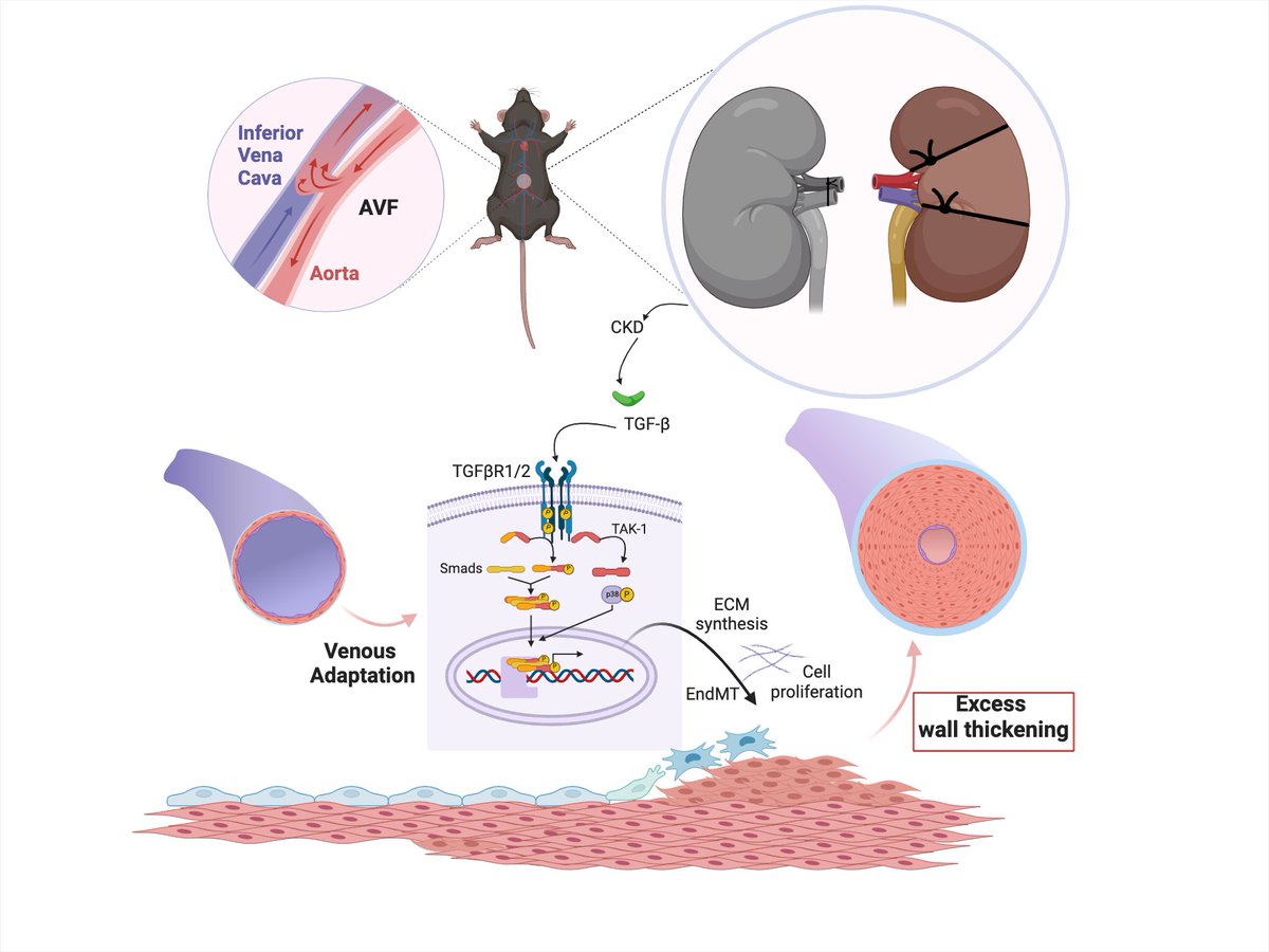 Alan Dardik MD PhD (@adardik) on Twitter photo Congratulations Weichang Zhang new <a href="/atvbahajournals/">ATVB: An AHA Journal</a> paper ahajournals.org/doi/abs/10.116… showing TGFβ regulation of EndoMT regulates AVF maturation in the CKD environment <a href="/YaleVascular/">Yale Vascular Surgery & Endovascular Therapy</a> <a href="/YaleSurgery/">Yale Surgery</a> <a href="/YaleVBTProgram/">YaleVBTProgram</a> <a href="/YaleMed/">Yale School of Medicine</a> <a href="/KathyMartinYale/">Kathleen Martin</a> Congratulations Weichang Zhang new <a href="/atvbahajournals/">ATVB: An AHA Journal</a> paper ahajournals.org/doi/abs/10.116… showing TGFβ regulation of EndoMT regulates AVF maturation in the CKD environment <a href="/YaleVascular/">Yale Vascular Surgery & Endovascular Therapy</a> <a href="/YaleSurgery/">Yale Surgery</a> <a href="/YaleVBTProgram/">YaleVBTProgram</a> <a href="/YaleMed/">Yale School of Medicine</a> <a href="/KathyMartinYale/">Kathleen Martin</a>