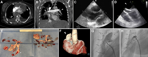 Cardiac Hydatidosis complicated with cysts pulmonary emboli. Treated successfully with large bore catheter aspiration ...amazing what you are able to aspirate with these devices!!

academic.oup.com/eurheartj/adva…