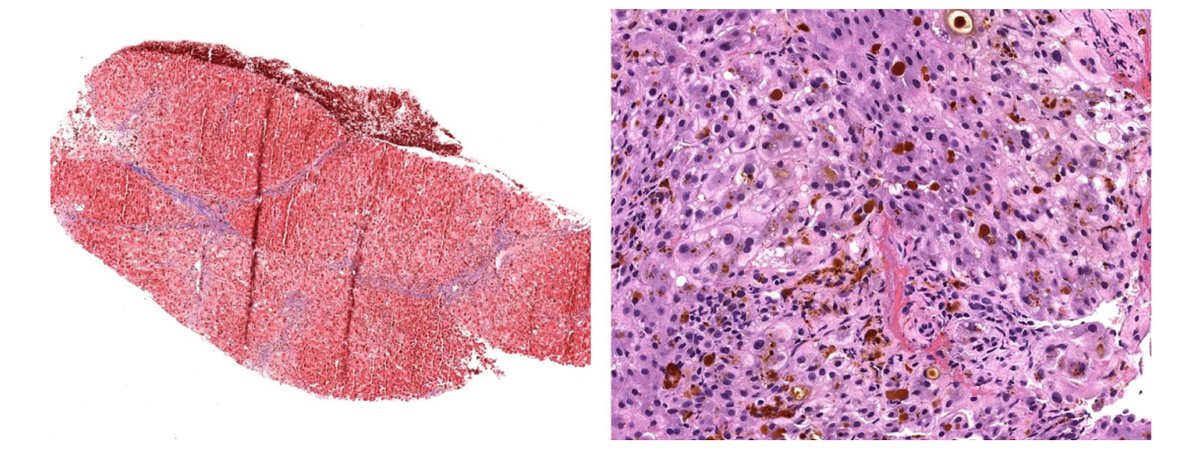👋#LiverTwitter

What is your diagnosis❓

41yo woman: dark urine, scleral icterus, fatigue, shortness of breath, RUQ pain

➡️AST 364U/L
➡️ALT 393U/L
➡️ALP 155U/L
➡️Bilirubin 9.2 mg/dl

➡️Progestin-only OCP 7wks prior

History of photosensitivity

Case🔗bit.ly/3XvVpsg