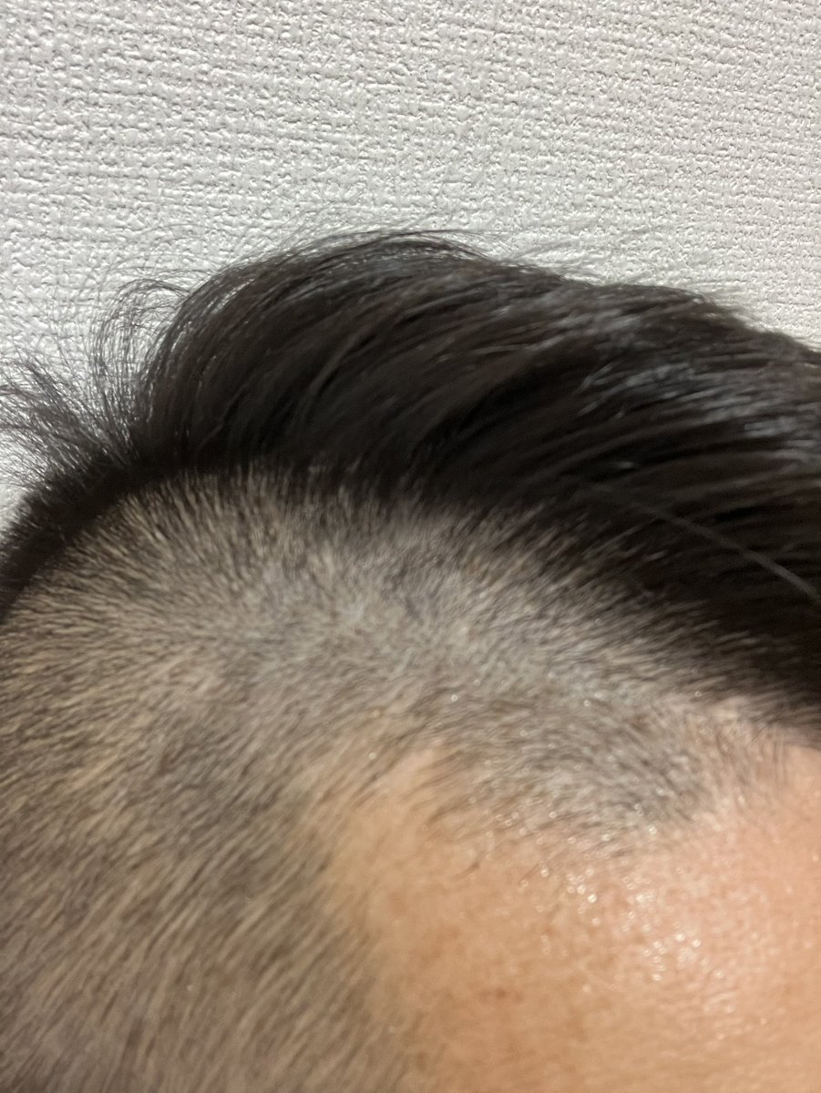 thurube_aga's tweet photo. 🌻リアップをM字部分だけつけて606日目 https://t.co/b0IFMyGGuP