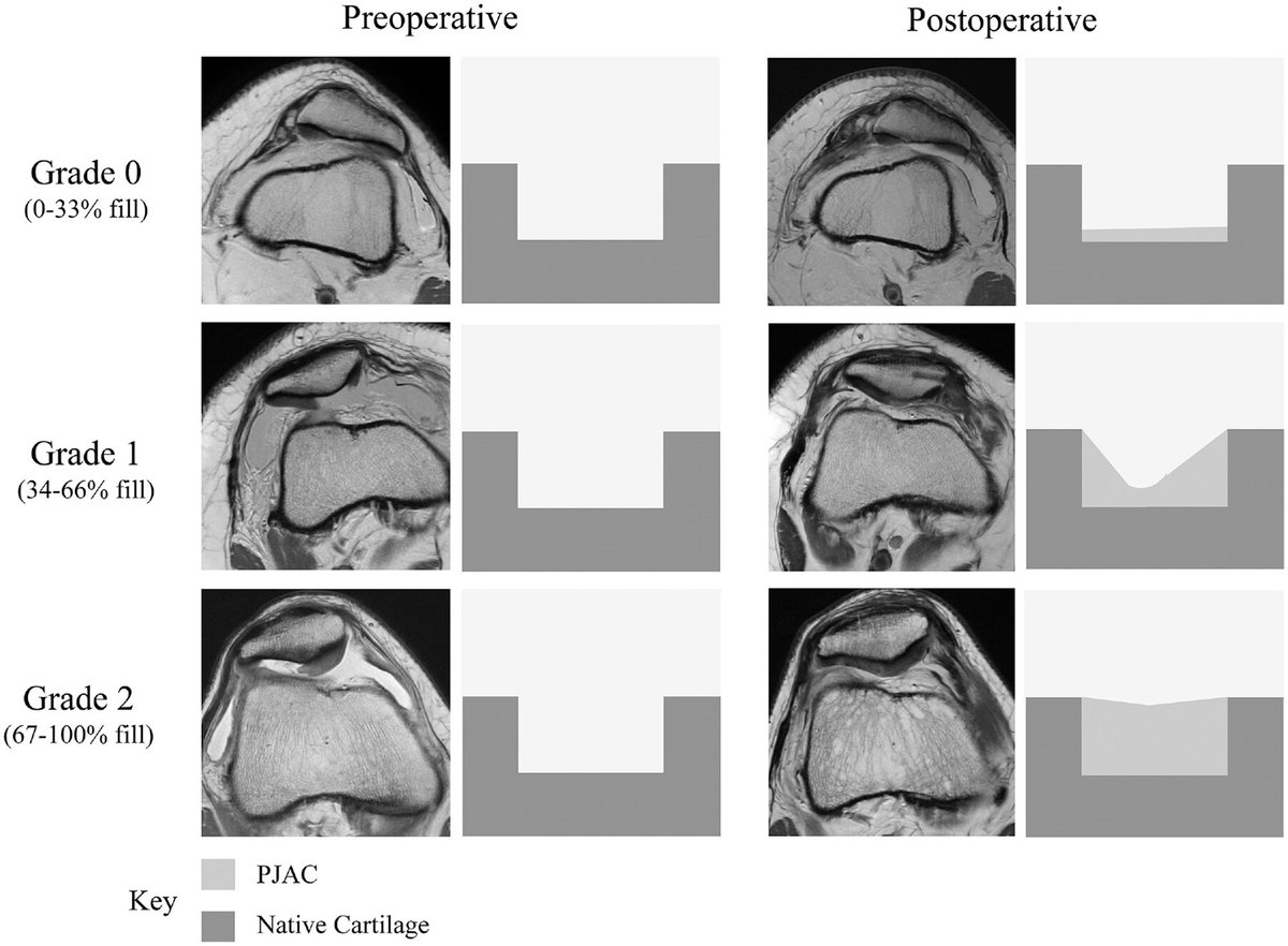 This retrospective review of patients treated with particulated juvenile articular cartilage for full-thickness patellar cartilage lesions demonstrates significant PROM improvements independent of defect fill percentage.

See the full study here! ow.ly/g3zi50Tk5VL