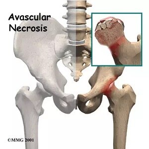 ParabSiddhesh's tweet image. Avascular necrosis (AVN), also known as osteonecrosis, is a painful  ..For more info visit...drsiddheshparab.com/latest-update/…