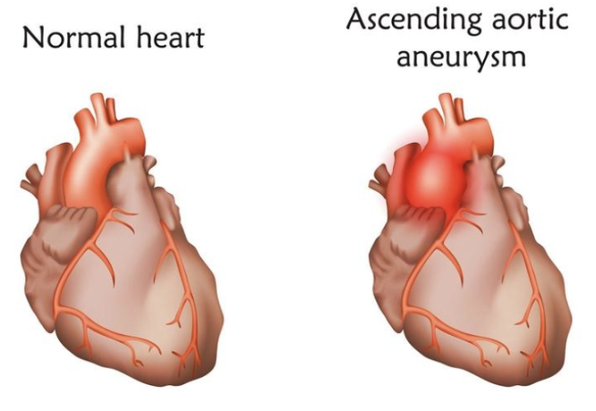 TSMA (@thoracicstudent) on Twitter photo Thoracic aortic diseases show significant sex differences. While men are more likely to develop thoracic aortic aneurysms (TAA), women face a 3x higher risk of dissection or rupture, often at smaller aneurysm sizes, and are 40% more likely to die than men from TAA Thoracic aortic diseases show significant sex differences. While men are more likely to develop thoracic aortic aneurysms (TAA), women face a 3x higher risk of dissection or rupture, often at smaller aneurysm sizes, and are 40% more likely to die than men from TAA