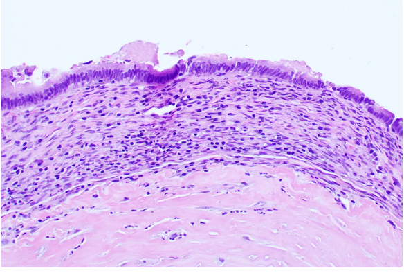 The new #PBPS Case of the Quarter is now available..
81 yo lady with incidental pancreatic body cyst.. well, this is just the tip of the iceberg!
Log in today to learn more about this fascinating case!
pbpath.org/case-5-quarter…
Thank you <a href="/FengYinMD/">Feng Yin</a> for sharing!