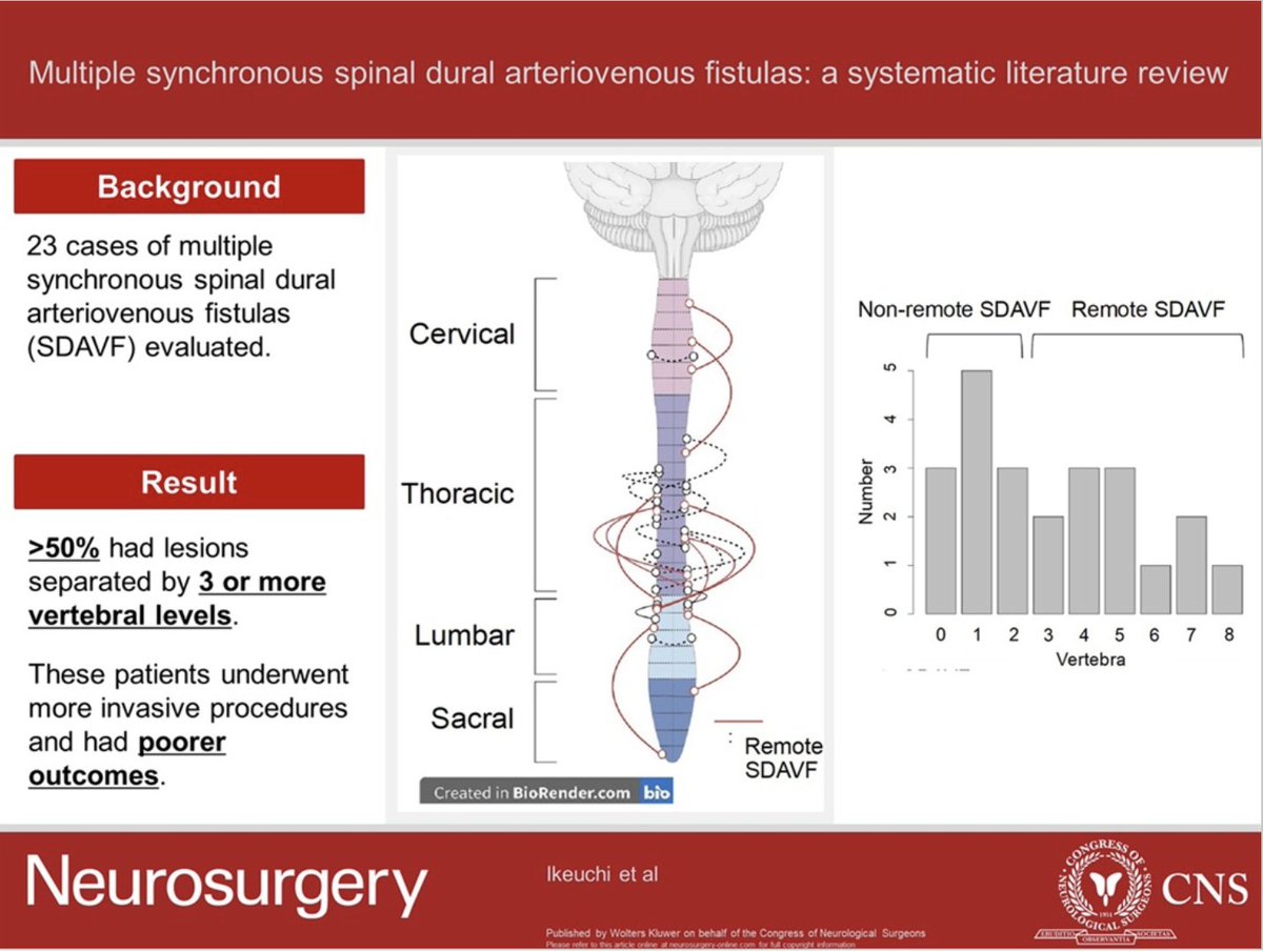 Neurosurgery Publications (@neurosurgerycns) on Twitter photo #NEUReview #NEUVisualAbstract Multiple Synchronous Spinal Dural Arteriovenous Fistulas: A Systematic Literature Review bit.ly/4gsI38L by Ikeuchi et al Kobe University Graduate School of Medicine <a href="/CNS_Update/">CNS</a> <a href="/JohnHShinMD/">John H. Shin MD, MBA</a> <a href="/Zaazoue/">Mohamed Zaazoue</a> <a href="/george_maragkos/">George Maragkos, MD</a> <a href="/urquiagajf_MD/">Jorge F. Urquiaga</a> <a href="/e_celano/">Emma Celano</a> #NEUReview #NEUVisualAbstract Multiple Synchronous Spinal Dural Arteriovenous Fistulas: A Systematic Literature Review bit.ly/4gsI38L by Ikeuchi et al Kobe University Graduate School of Medicine <a href="/CNS_Update/">CNS</a> <a href="/JohnHShinMD/">John H. Shin MD, MBA</a> <a href="/Zaazoue/">Mohamed Zaazoue</a> <a href="/george_maragkos/">George Maragkos, MD</a> <a href="/urquiagajf_MD/">Jorge F. Urquiaga</a> <a href="/e_celano/">Emma Celano</a>