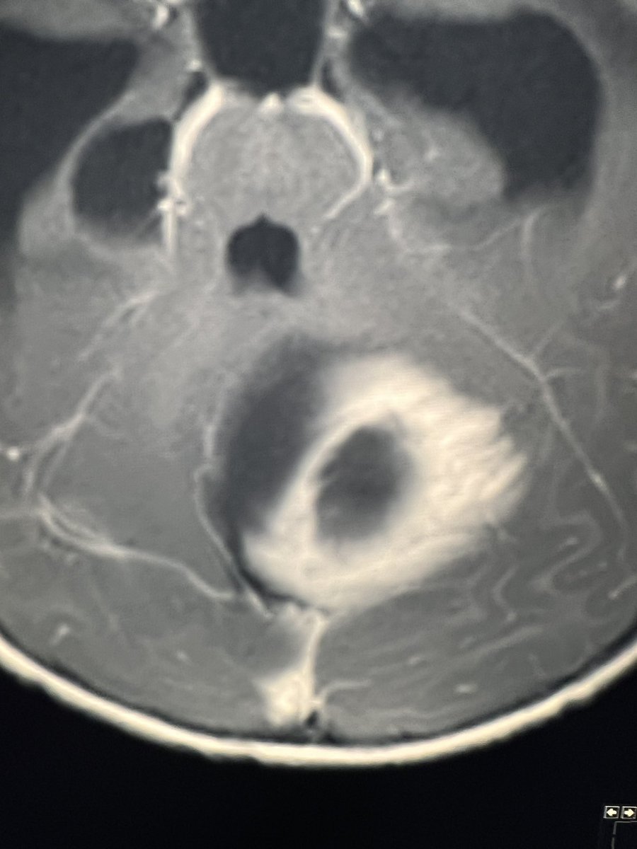 Tip of the day 💡: The “out of focus picture” type of contrast enhancement is a feature of astrocytic tumors. In this case, a pilocytic astrocytoma of the posterior fossa.