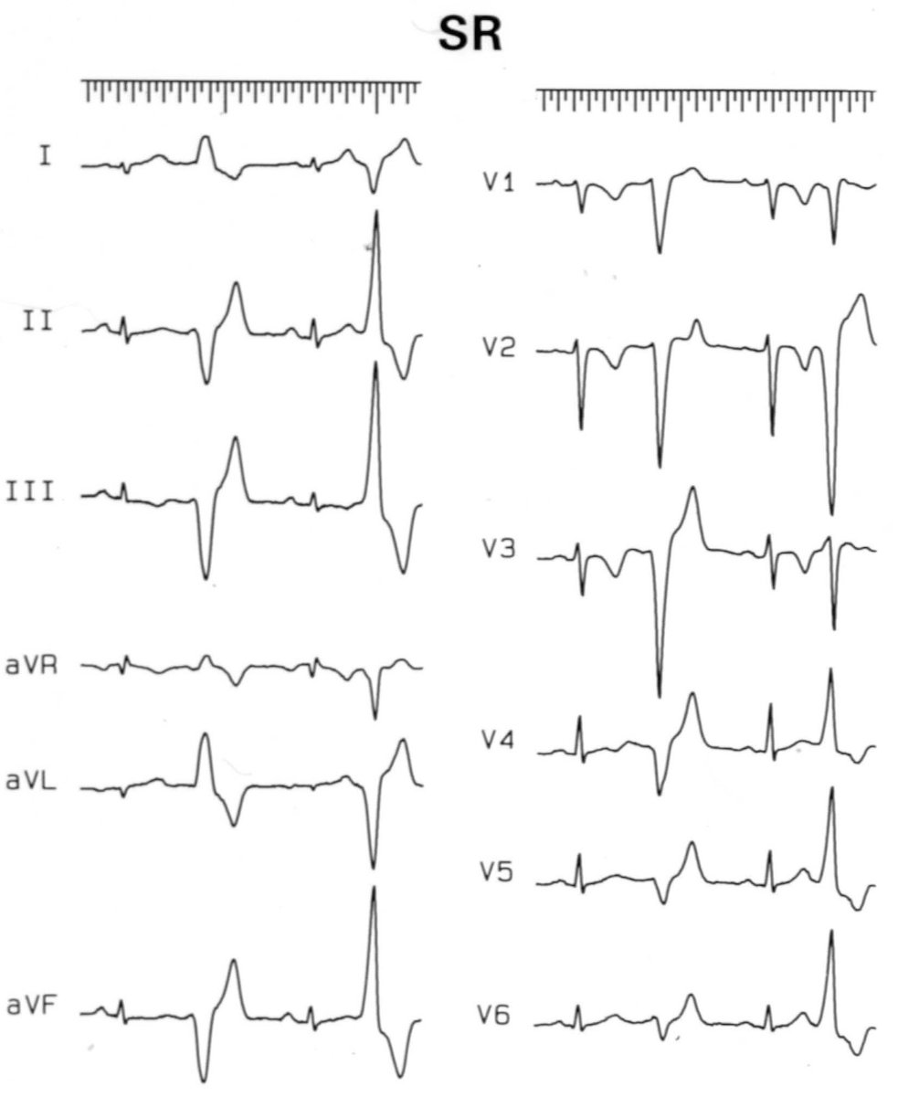 Jose Luis Merino (@joselmerino) on Twitter photo 📅 Mark your calendars for the EHRA webinar on 12-lead ECGs in structural heart diseases! 🫀
🗓️ October 14th, 18:00 CET
🌍 Open to all ECG enthusiasts!
Don’t miss this opportunity to deepen your ECG diagnostic skills. Join us! #ECG #EHRA <a href="/EHRAPresident/">EHRAPresident</a>
esc365.escardio.org/event/1568 📅 Mark your calendars for the EHRA webinar on 12-lead ECGs in structural heart diseases! 🫀
🗓️ October 14th, 18:00 CET
🌍 Open to all ECG enthusiasts!
Don’t miss this opportunity to deepen your ECG diagnostic skills. Join us! #ECG #EHRA <a href="/EHRAPresident/">EHRAPresident</a>
esc365.escardio.org/event/1568