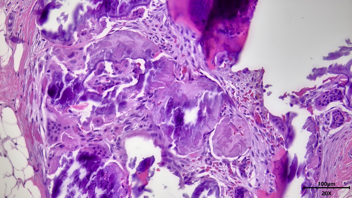 VickeryJasmine's tweet photo. Breast core needle biopsy done for calcifications, initial thoughts? #Pathology #PathTwitter #pathresidents #PathX #breastpath #pathologists #Histology https://t.co/kN2WLznLiU