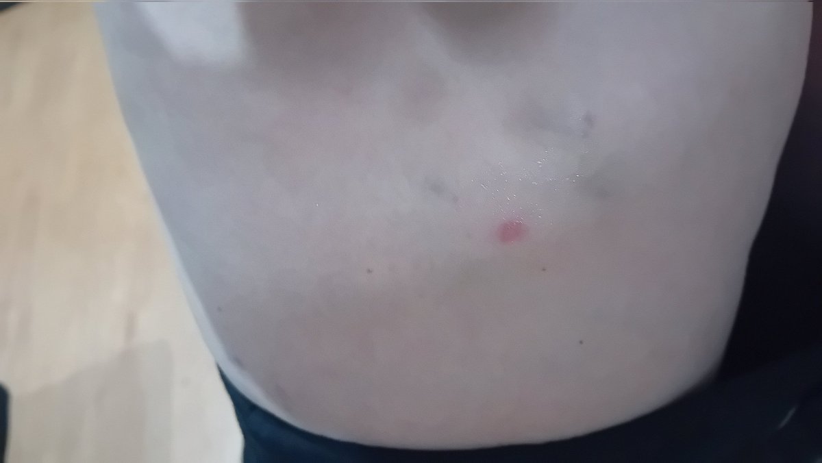 Mi sono svegliata due giorni fa con questo morso..peggiora ogni giorno, mi gratto, ora sono nate echimosi intorno...cosa può essere? Domani andrò in urgenza