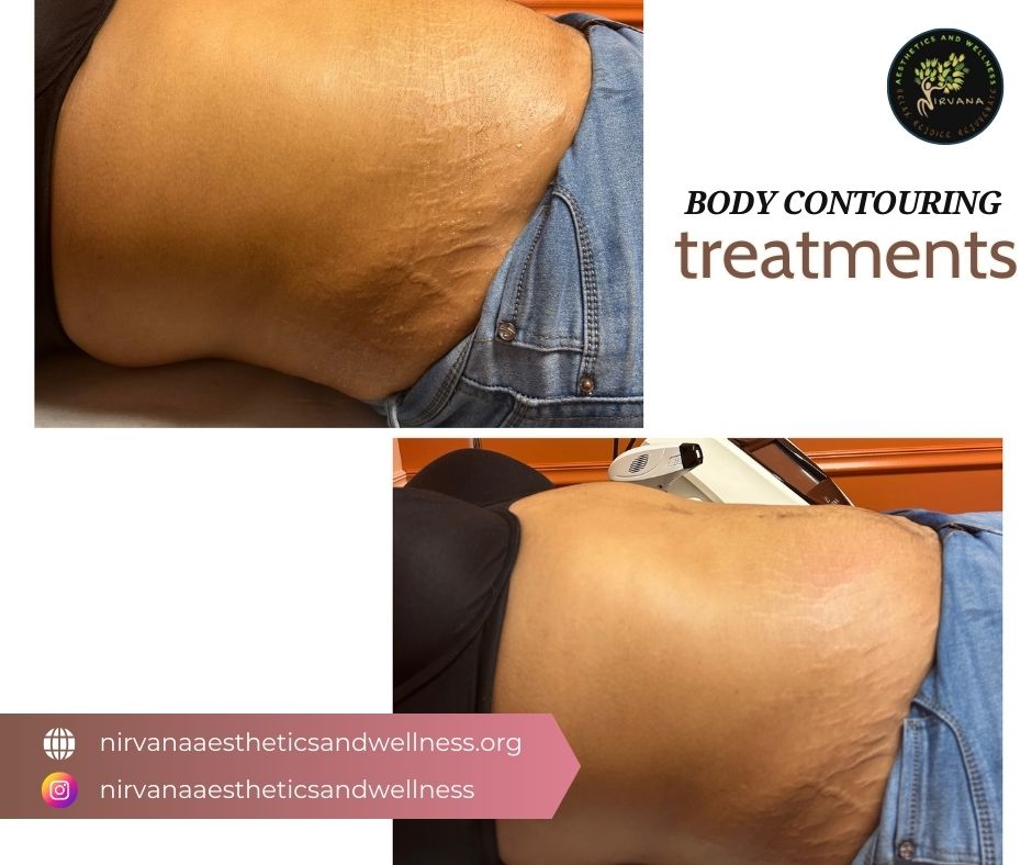 nirvanaconyers's tweet photo. Achieve your dream body with our advanced body contouring treatments! Say goodbye to stubborn fat and hello to a more sculpted you. Book your session today and step confidently into a new you! #BodyContouring #ConfidenceBoost #SculptYourself #Nirvana #bodytreatment https://t.co/XfmMuAabhp
