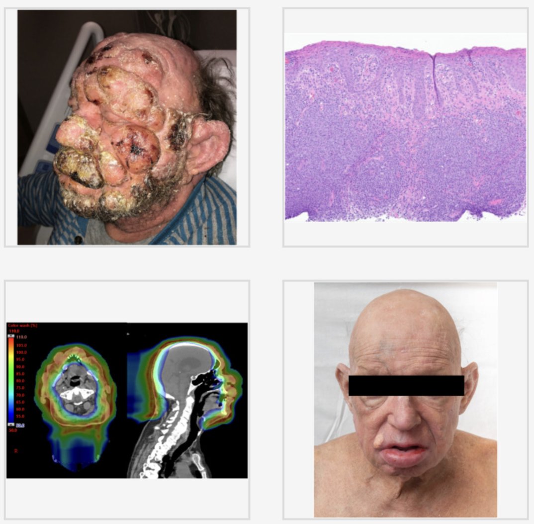 Remarkable case report.

RT for leonine facies in CTCL.

20 Gy/4 fx protons then 12 Gy/8 fx electrons – completely life changing for the patient.

advancesradonc.org/article/S2452-…