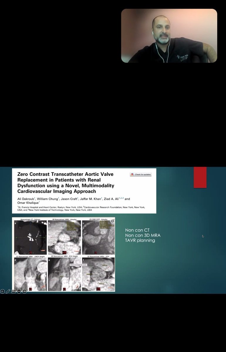 AzkaNaeemMD's tweet image. Happening now monthly series of heart trending 
&quot; invasive imaging for structural heart intervention&quot; by @OKhaliqueMD and @chadialraies 
Tune in now 
us02web.zoom.us/j/84403357630

@mca_heart #multimodalityimaging #CardioTwitter