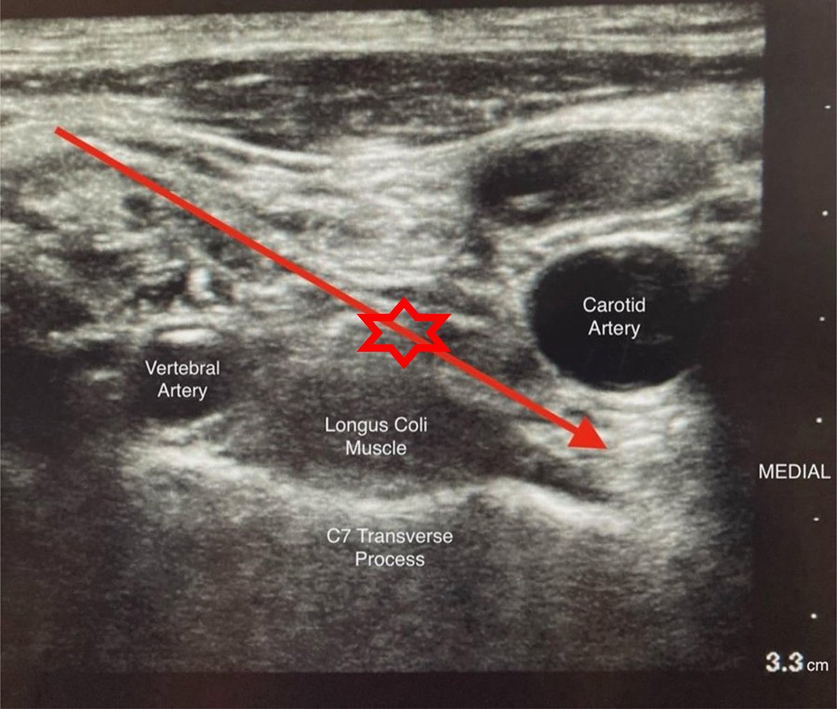 OJiravsky's tweet photo. @JACCJournals I would attack the ganglion stellatum rather in the place where I painted the red star, not where the authors placed the arrow https://t.co/UAXz1sDGrM