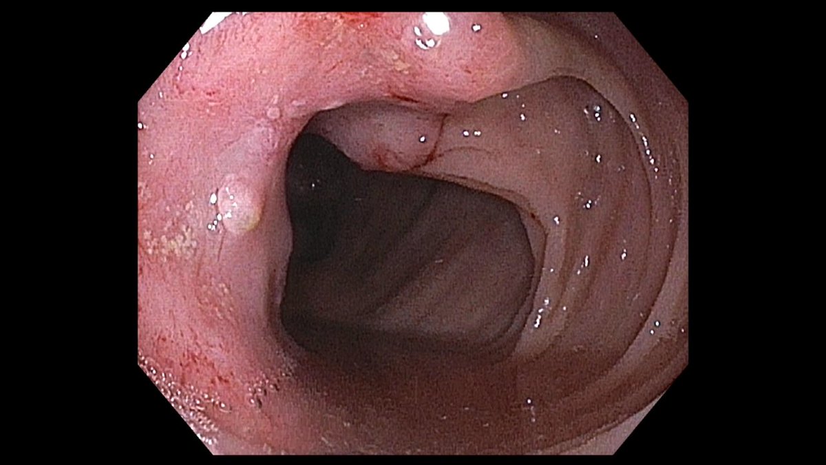 YeseongDavid's tweet photo. Inpatient colon done for IDA, this was found in ascending colon. No prior colonoscopy, highlights importance of screening for a preventable outcome. https://t.co/Pwuv14aNl9