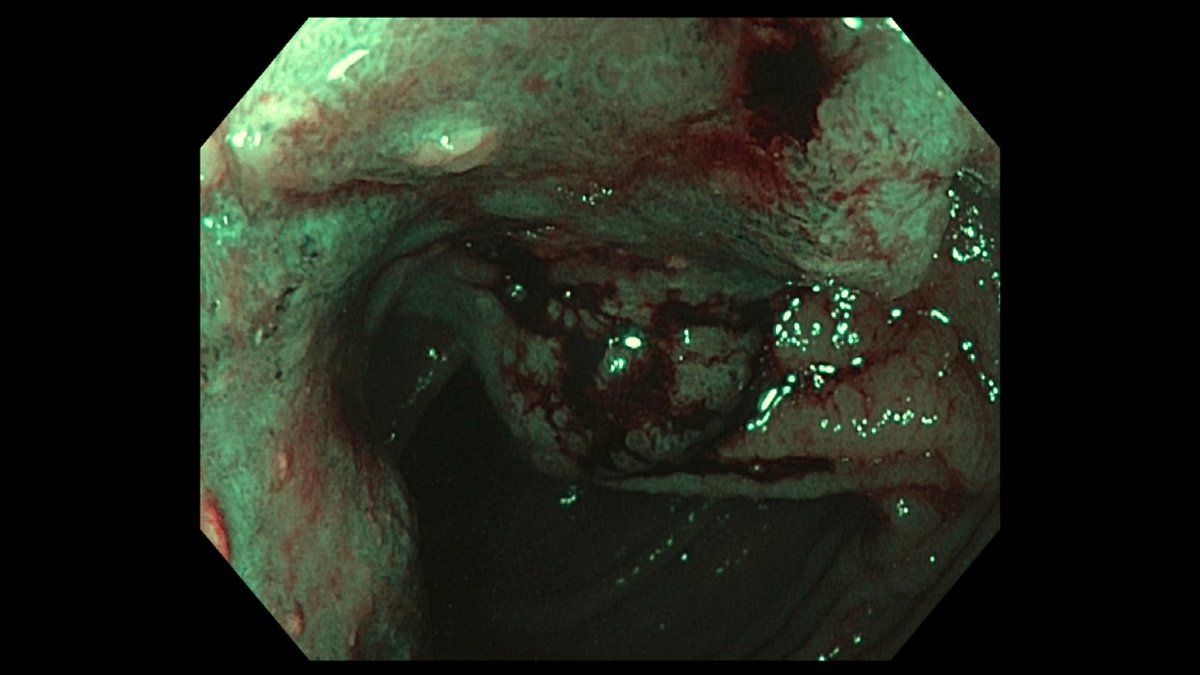 YeseongDavid's tweet photo. Inpatient colon done for IDA, this was found in ascending colon. No prior colonoscopy, highlights importance of screening for a preventable outcome. https://t.co/Pwuv14aNl9