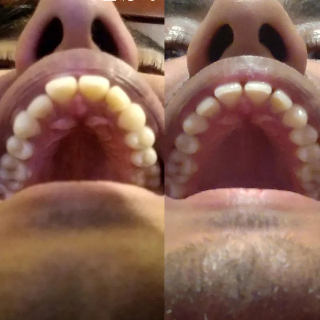 JohnFlutter's tweet image. His teeth appear to be naturally aligning after postural correction:
This is virtually impossible according to mainstream orthodontics, especially at age 23.
...after only 8 months.
How did he do it?
By keeping the mouth closed at rest, lips gently together, and tongue on the…