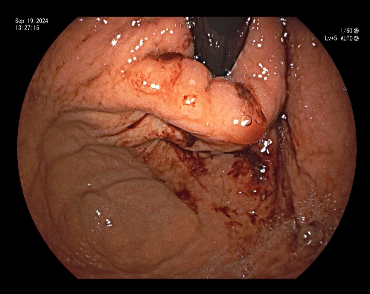 YeseongDavid's tweet photo. Total incisionless fundoplication (TIF) done in endo suite! I've been promoted from invaginator to retroflexor 😆 https://t.co/sIHlccQDUy