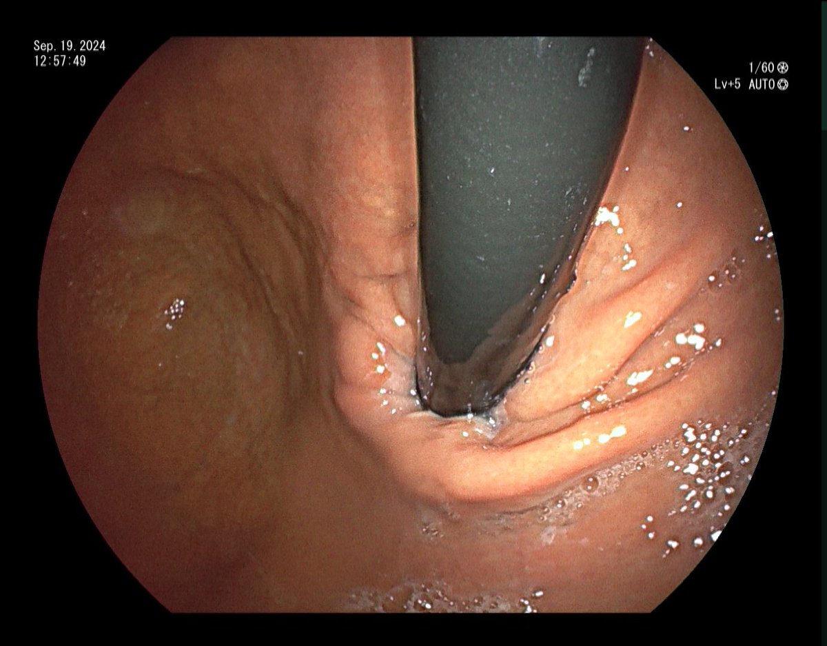 YeseongDavid's tweet photo. Total incisionless fundoplication (TIF) done in endo suite! I've been promoted from invaginator to retroflexor 😆 https://t.co/sIHlccQDUy
