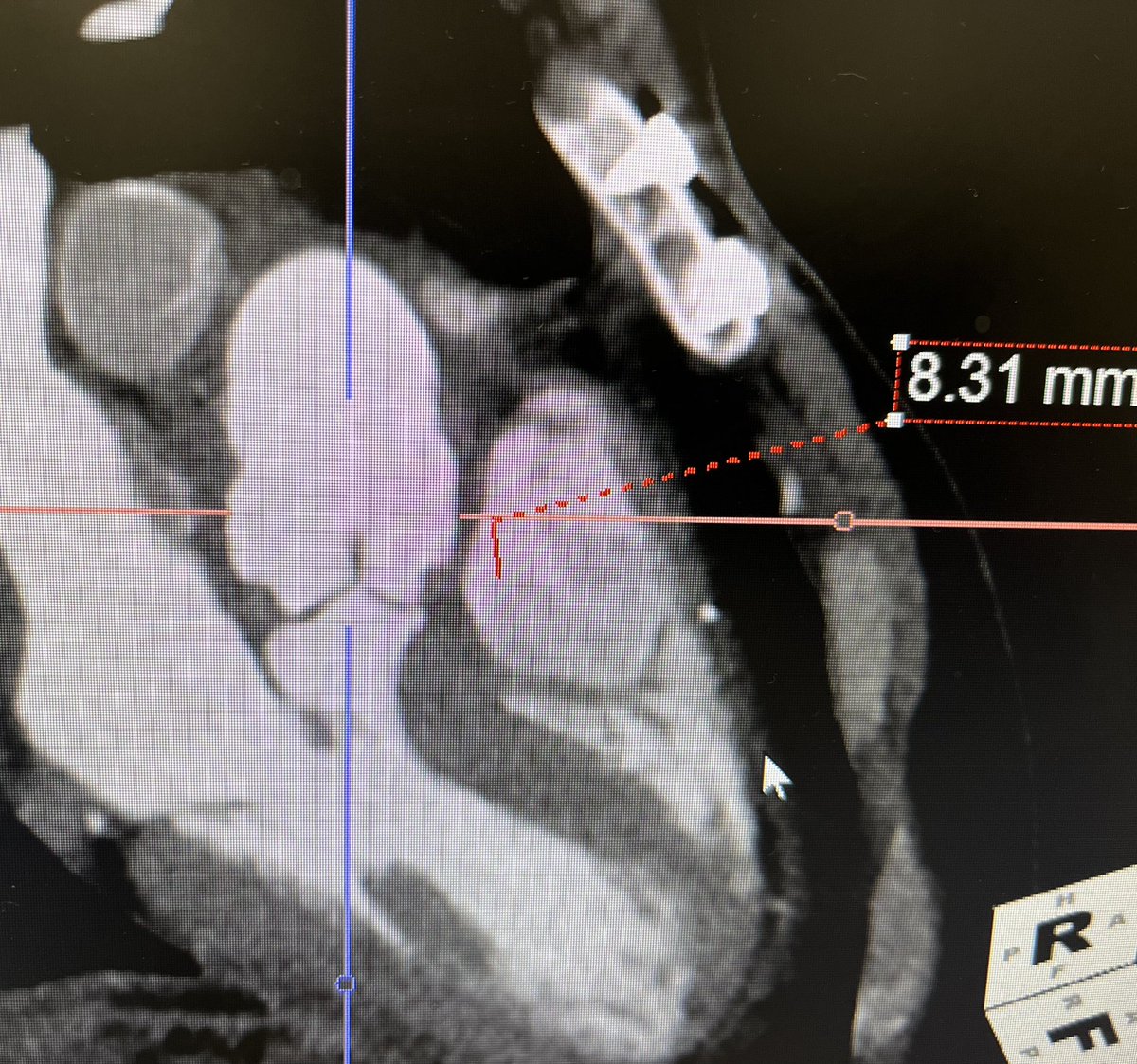EricRoselliMD's tweet photo. 10/10 Let’s spread the word about improving care for aortic patients!!@Heart_Valve @BAVTAD @CXAortic @AortaWomen @AorticDissectCT @ThinkAortaUS @HeartValveOrg @AorticHope #AortaEd #AorticAwareness https://t.co/JKma6sz9JQ