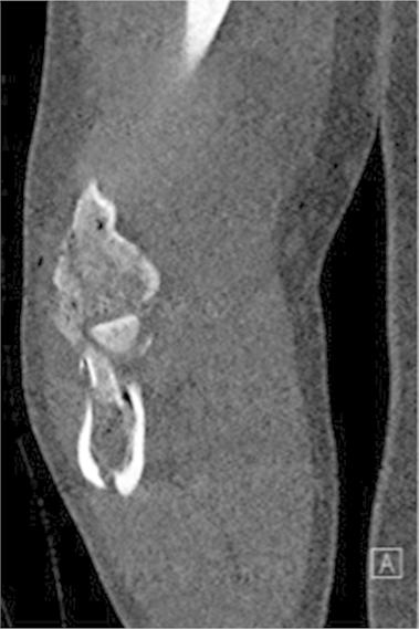 jbjs's tweet photo. Custom Capitellum Hemiarthroplasty

https://t.co/nVbvqEfFj1 https://t.co/fhQrFSuLah