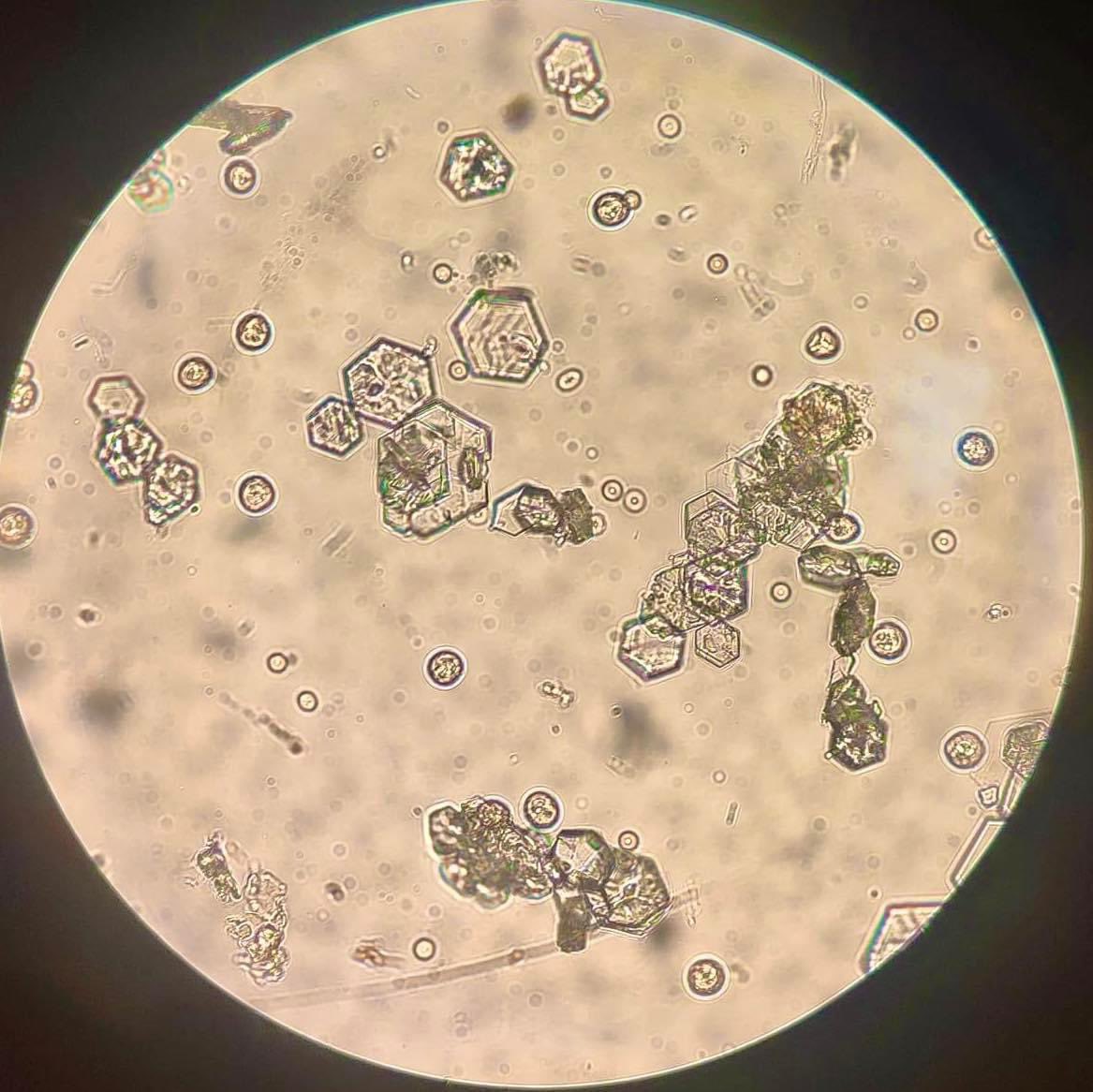 LabClinicoDG's tweet photo. Cristales de cistina en sedimento urinario 🔬🔍

https://t.co/rq480Rrx2h

#uroanalisis https://t.co/fY8qhzPjQv