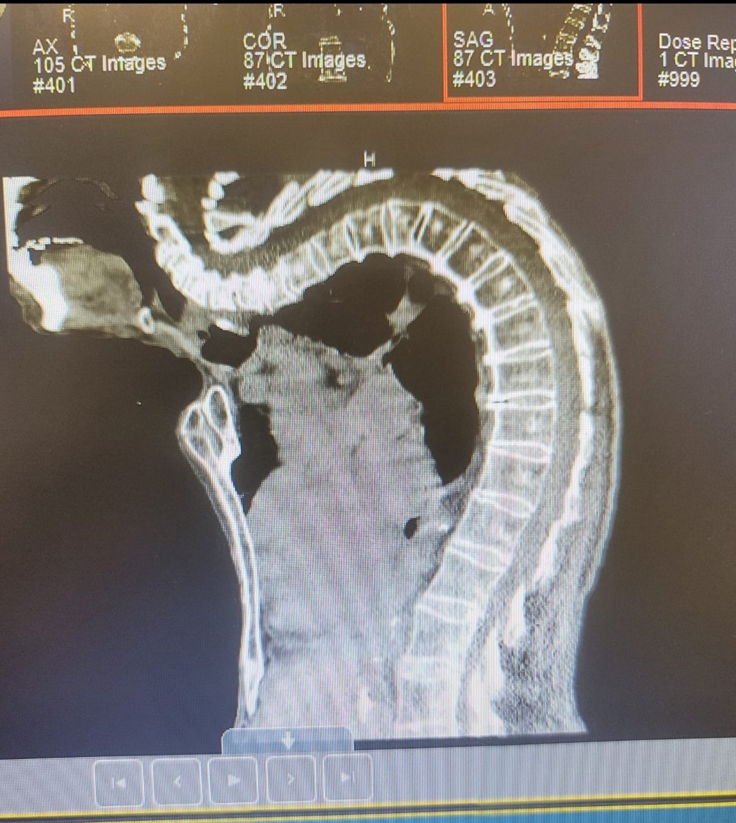 AngelMD1103's tweet image. Did you know scoliosis is a sideways curve of the spine that typically appears during the growth spurt before puberty? Stay informed about your spine health! ✨ #SpineFacts #ScoliosisAwareness