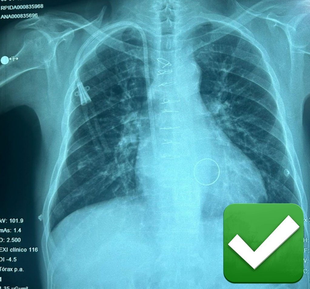 Nueva etapa: de aprendices a líderes. Terminamos con éxito nuestro primer tunelizado 💯 autónomos R3 (Elisa) y Fellow. Mentor: <a href="/bernardo_moguel/">Bernardo Moguel-Gonzalez</a> <a href="/brendacfl/">Brenda Cortez</a> <a href="/CharuMalik_ISN/">Charu Malik</a> <a href="/ISNkidneycare/">Int Society of Nephrology</a> #InterventionalNephrology #HandsonTraining #INCICH #Slanh #ISNAcademy