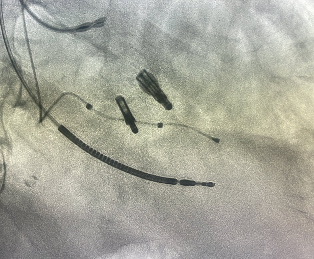 Hemodynamics after a successful #Mitraclip. V wave down from 81 to 28.
Patient felt better on the first day itself. No orthopnea and no breathlessness.
#MitraClip #Mitral regurgitation
#BreachCandyHospital