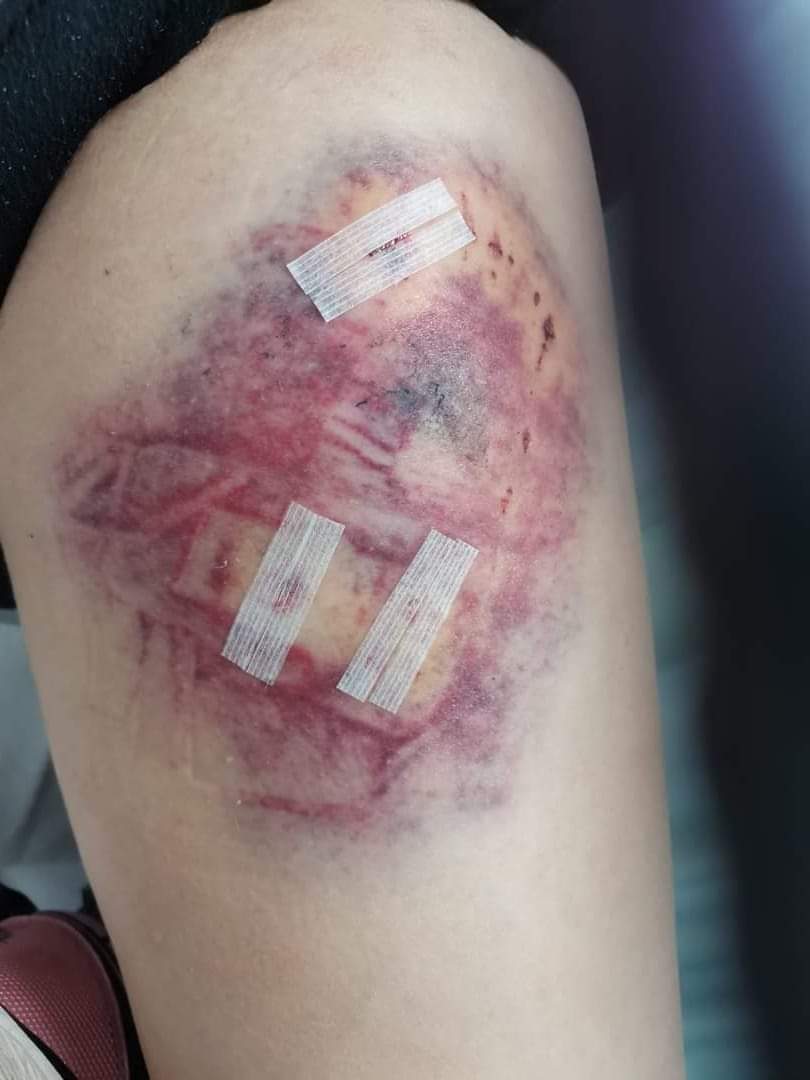 tasha_f_P's tweet photo. Been over 18 months since I got this beauty of a bruise on my thigh from a roaming dog. 
If I press on it, it's still hurts. 

Today, I just helped an elderly dog get home after he walked out in front of my car. :(

People don't deserve animals.
#Dog #Dogbite #KeepDogsContained https://t.co/oestGZ8mgE