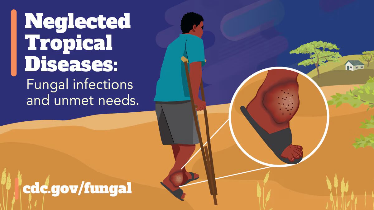 WHO recognized mycetoma as a NTD. The global burden remains poorly defined. Early detection &amp; treatment are vital to reduce morbidity &amp; improve outcomes. ~3683 cases in Uganda. Clinicians have a low index of clinical suspicion leading to under-diagnosis. #Fungalweek24