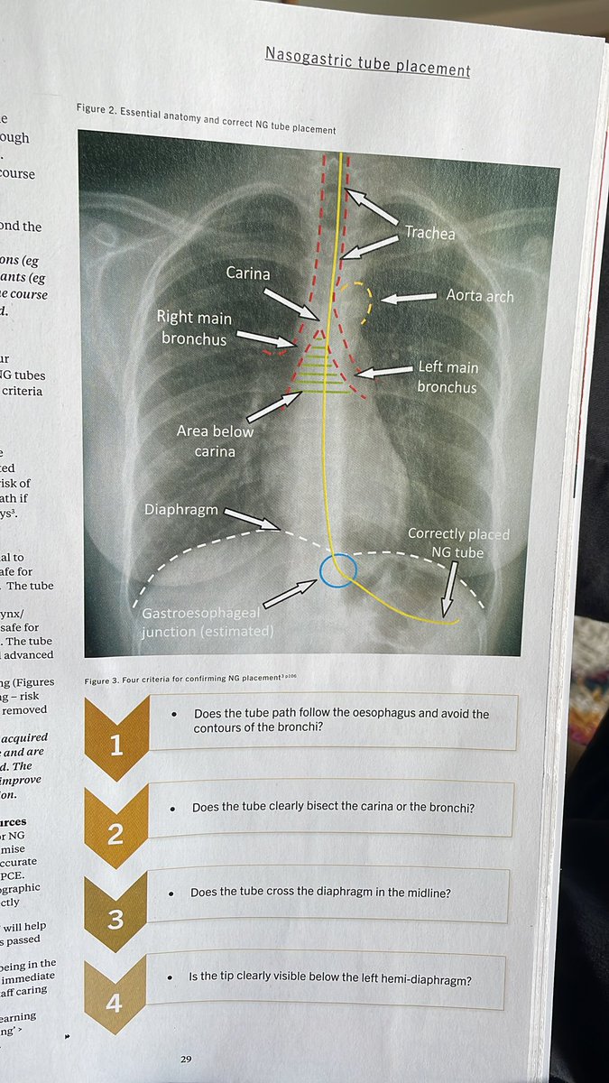 Martin Mitchell (@mrmitchell1969) on Twitter photo <a href="/RadSocCCCU/">CCCURadSoc</a> nice article by <a href="/g_cain/">Gavin Cain</a> in this month’s synergy about #PCE in nasogastric tube placement .
Useful resource all #radiographers should be aware of.
Use the 4 criteria to determine correct NG tube position.
<a href="/SCoRMembers/">SCoR Members</a> <a href="/RadSocCCCU/">CCCURadSoc</a> nice article by <a href="/g_cain/">Gavin Cain</a> in this month’s synergy about #PCE in nasogastric tube placement .
Useful resource all #radiographers should be aware of.
Use the 4 criteria to determine correct NG tube position.
<a href="/SCoRMembers/">SCoR Members</a>
