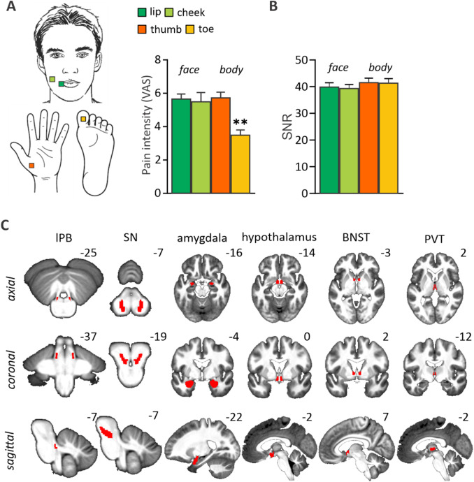 #NewPaper supported by NIF <a href="/MBCIU_UoM/">MBCIU</a>:

Differential activation of lateral parabrachial nuclei &amp; their limbic projections during head compared with body pain: A 7Tesla functional magnetic resonance imaging study

doi.org/10.1016/j.neur…

@rvrrobertson <a href="/LNSFSydney/">KevinKeay&LNSF</a> <a href="/LukeHenderson_1/">Prof Luke Henderson</a>