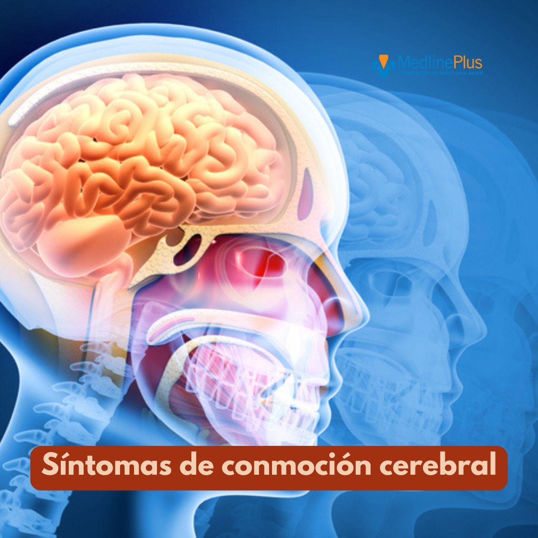 MedlinePlusEsp's tweet image. Una conmoción cerebral es un tipo de lesión que ocurre cuando un golpe en tu cabeza o cuerpo provoca que ésta se mueva violentamente, golpeando el cerebro contra el cráneo. En ocasiones, puede dañar las células cerebrales. Entérate ow.ly/l2ZR50TqMwJ #ConcussionAwarenessDay