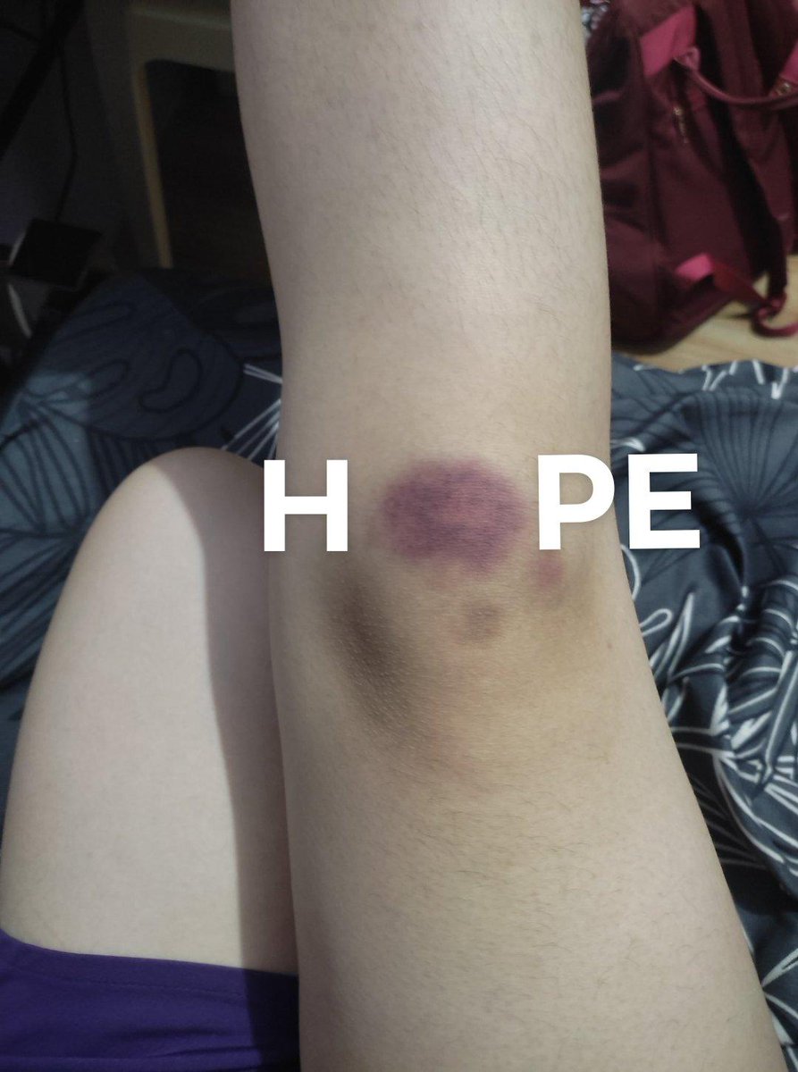 allaena_j's tweet photo. tw// bruise(s)

HOPE! 😍 https://t.co/5E7tl0xXRX