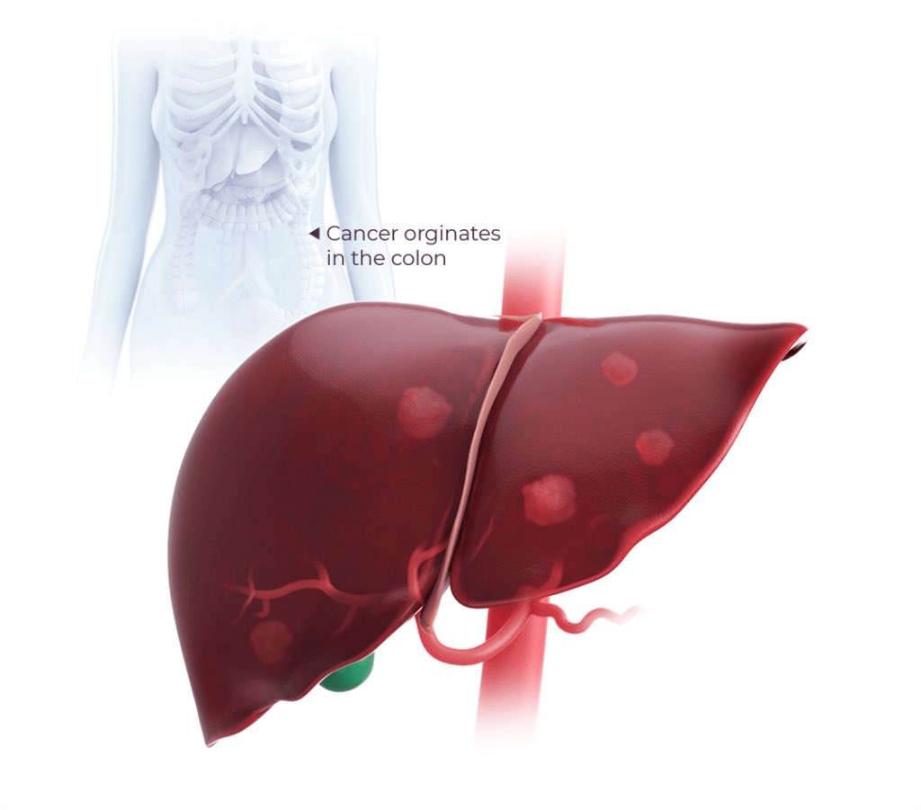 Giovanni Marchegiani (@gio_marchegiani) on Twitter photo 🏔️ A new milestone has been reached!
🔵 Out now in <a href="/TheLancet/">The Lancet</a> Transmet Trial
💥 Liver Transplantation + chemotherapy superior to chemo alone in permanently unresectable CRLM
📈 5-year overall survival 56·6% vs. 12.6%
A new era has begun?! 🧐
sciencedirect.com/science/articl… 🏔️ A new milestone has been reached!
🔵 Out now in <a href="/TheLancet/">The Lancet</a> Transmet Trial
💥 Liver Transplantation + chemotherapy superior to chemo alone in permanently unresectable CRLM
📈 5-year overall survival 56·6% vs. 12.6%
A new era has begun?! 🧐
sciencedirect.com/science/articl…