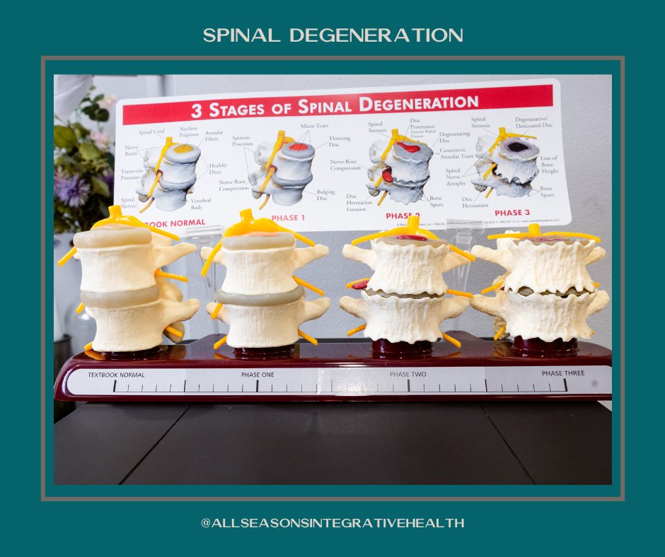 DrPaulMBekkum's tweet image. Fun Fact Friday: 🧠 Your spine is strongest when it maintains its natural S-curve. This alignment helps distribute weight and absorb shock, reducing injury risk. Keep your posture in check for a healthy spine! 🧍‍♀️ #SpineFacts #GoodPosture #HealthTips