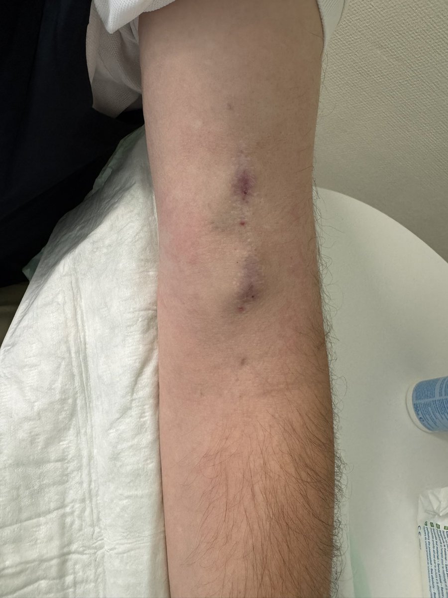 robshahverdyan's tweet photo. 5,5 years old @Medtronic #Ellipsys #pAVF #endoAVF patient visiting for annual routine follow up and very satisfied with how their arm looks like as compared to the #ESKD neighbors at HD unit 💪🏻💪🏻💪🏻 https://t.co/kSrPr66Bac