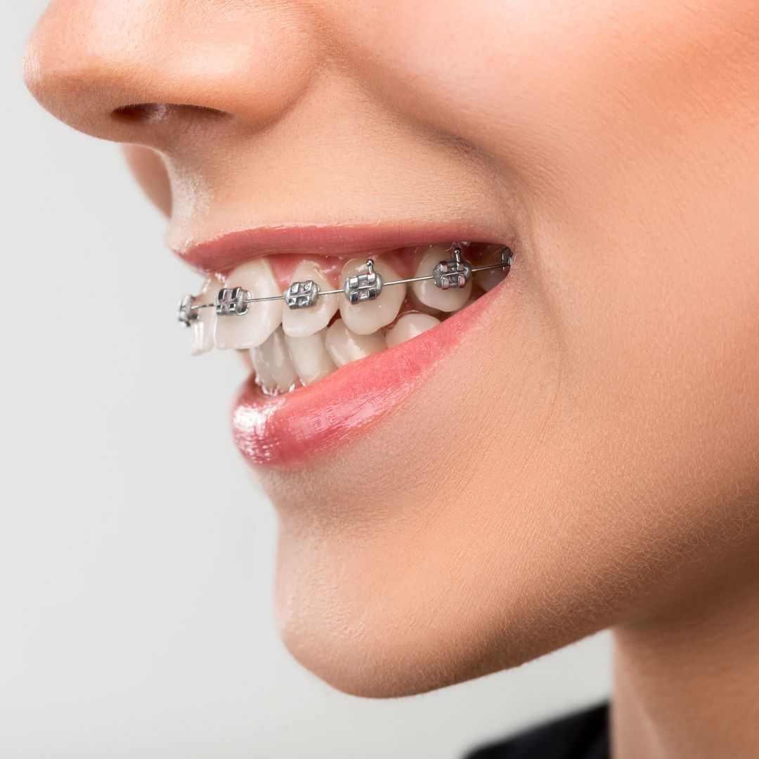 GalkinOrtho's tweet image. Are you dealing with an overbite that affects your smile and confidence? Braces are a highly effective solution for correcting overbites, helping you achieve a balanced, beautiful smile. 

☎️ 732-636-2828
Learn More: buff.ly/3HX5cAA
.
.
#galkinorthodontics #overbite